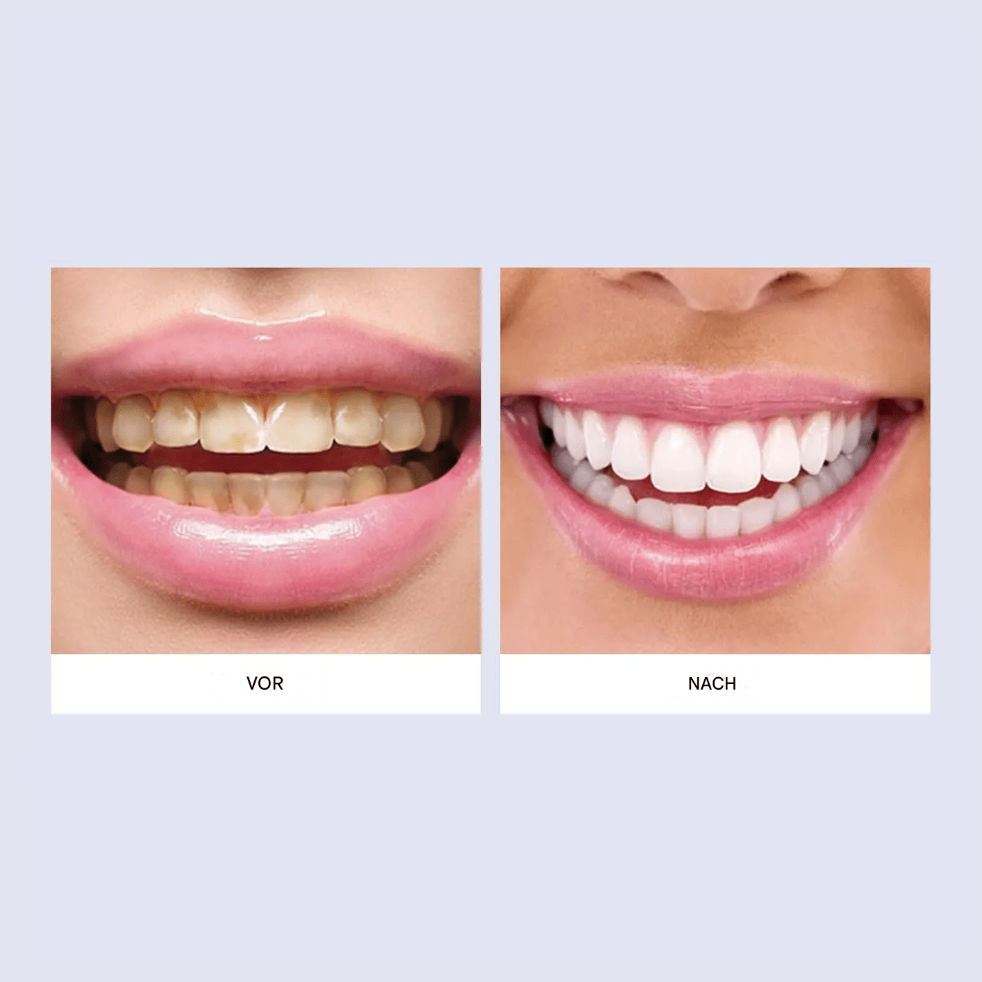 Tannkrem for bleking og beskyttelse