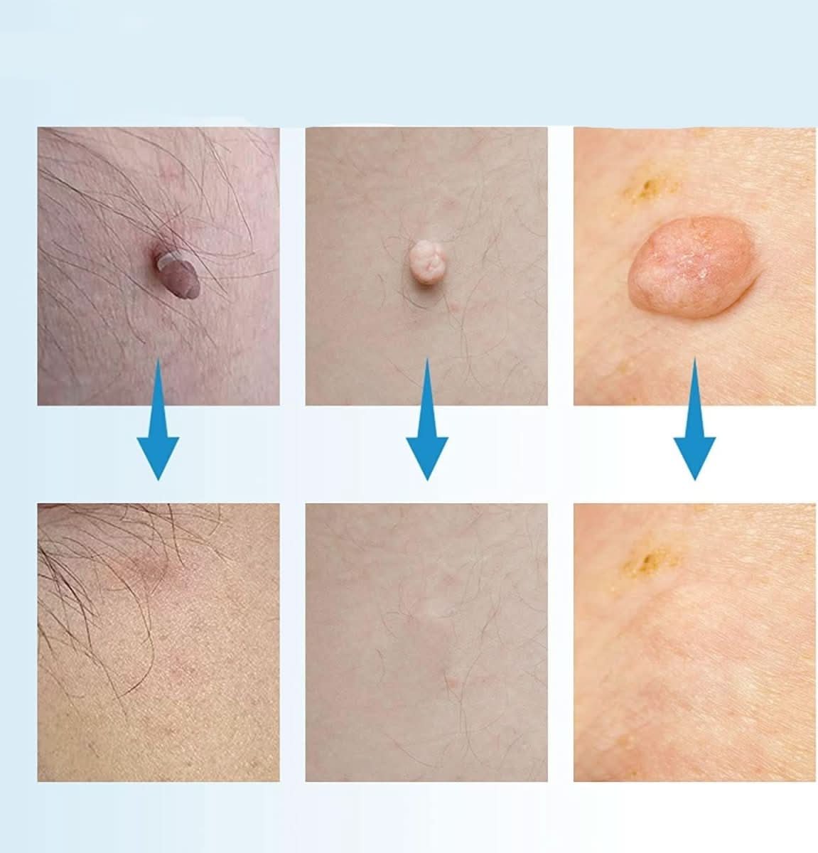 Mittelgroßer, weißer Hautfleckenentferner zur schmerzfreien und schnellen Entfernung von Hauttags, Alterswarzen und Muttermal
