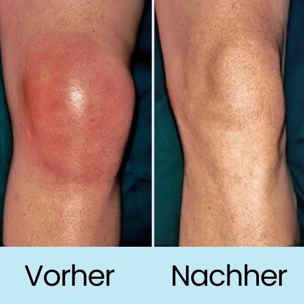 "Knie-Schmerzpflaster zur natürlichen Schmerzlinderung, einfach anzuwenden, auf Knie aufgeklebt für gezielte Erleichterung."