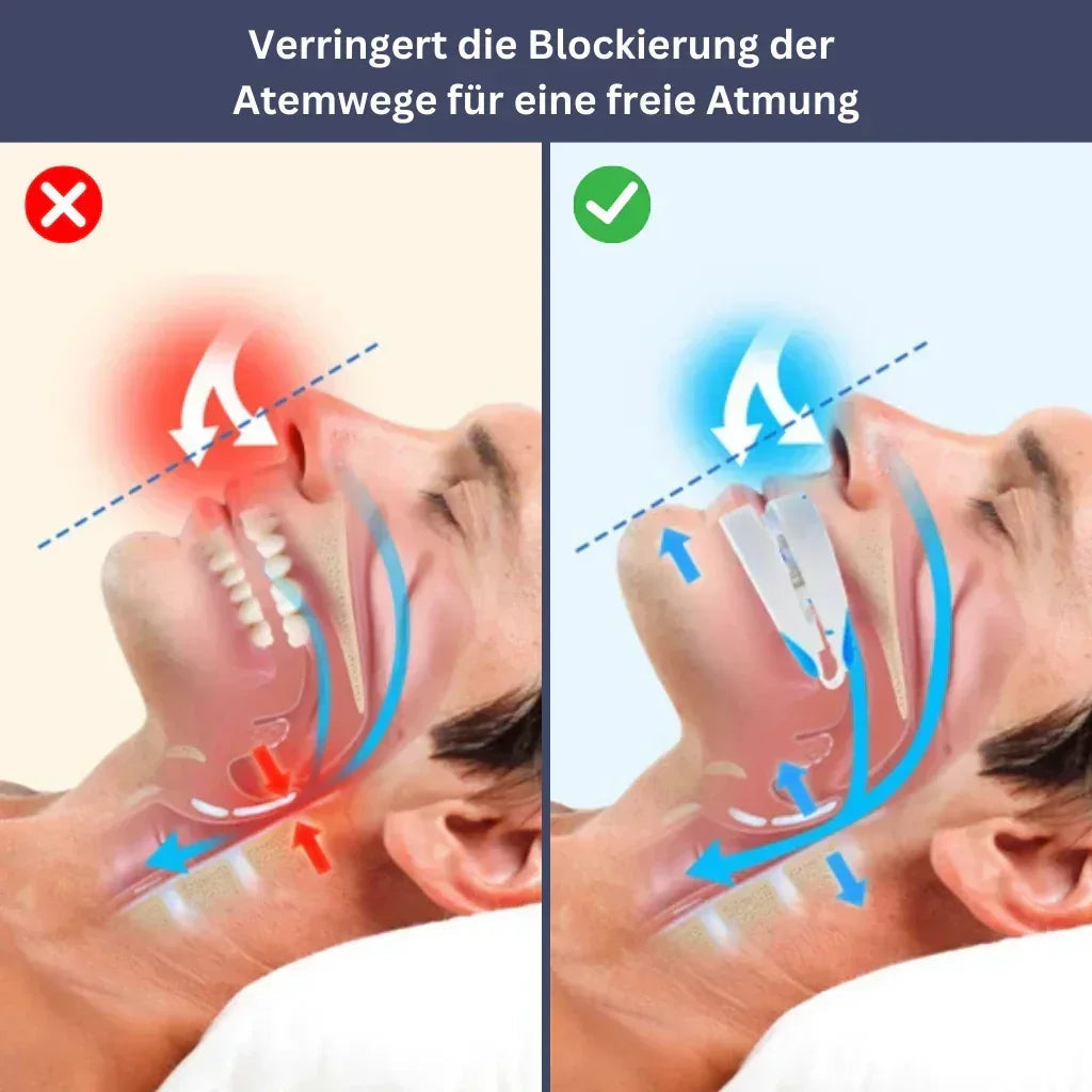 Schnarchschiene für erholsamen Schlaf, ergonomisch, passt sich der Mundform an, reduziert Schnarchen, verbessert Luftfluss.